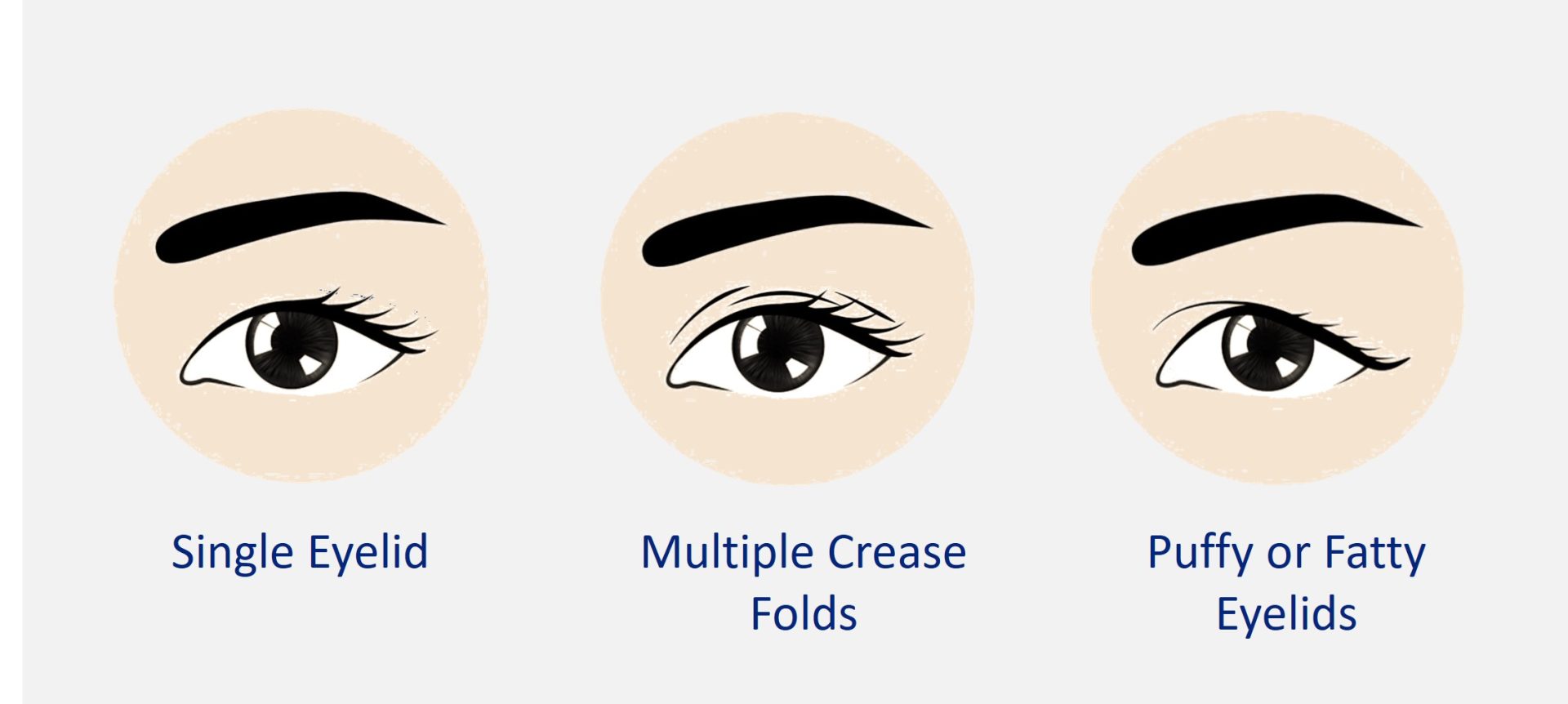 candidates for double eyelid surgery