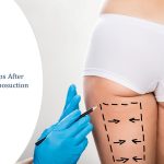 care tips after liposuction