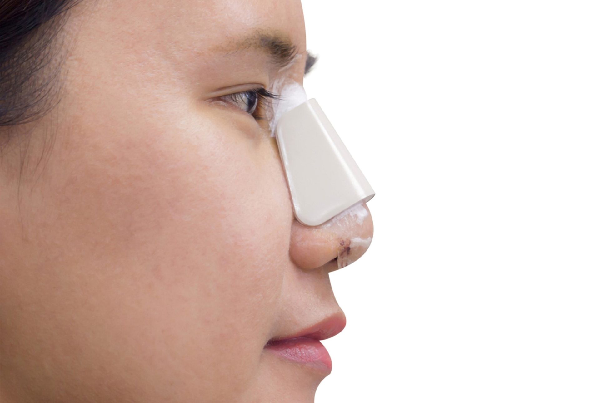 cast on nose after rhinoplasty