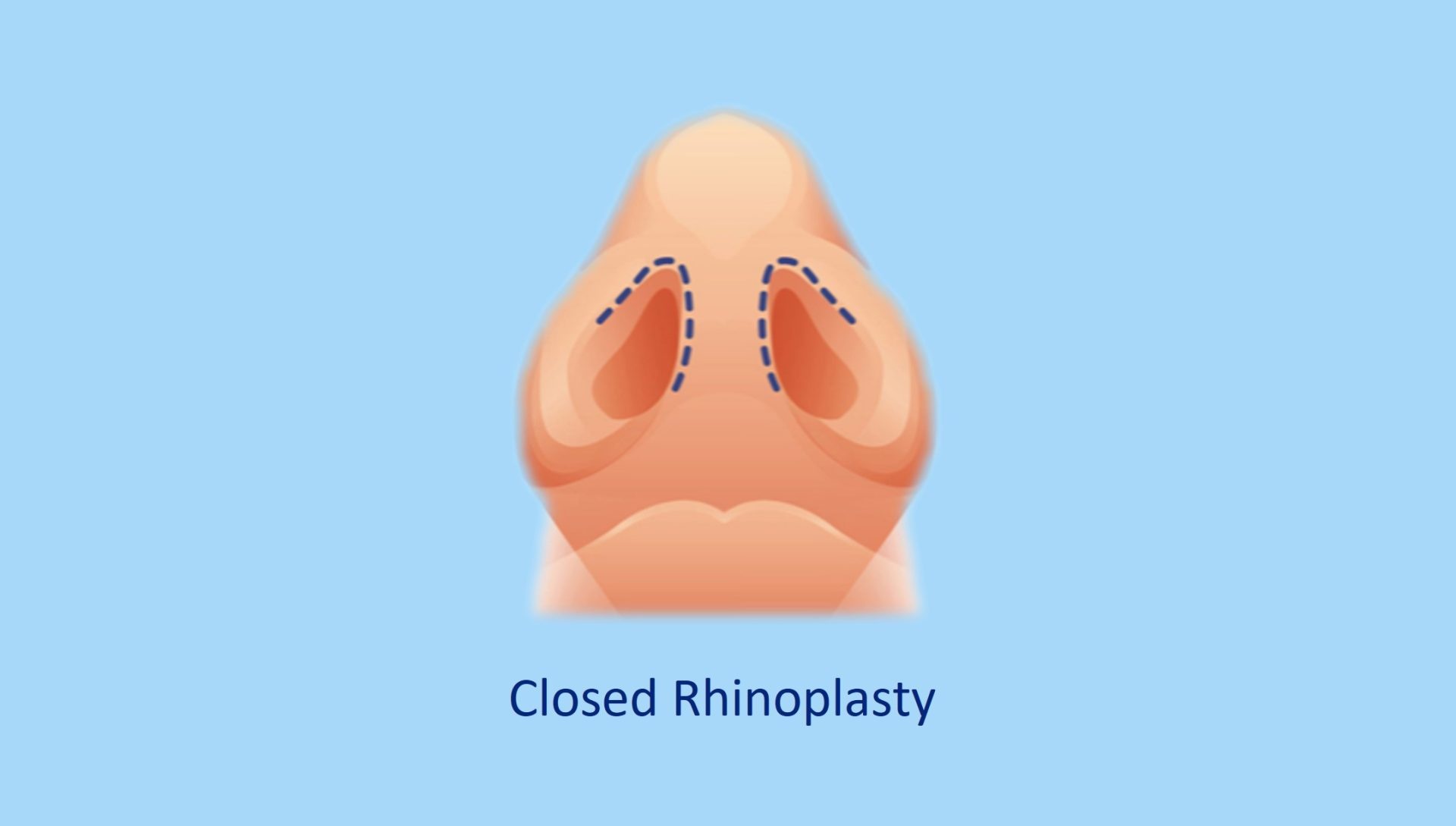 closed rhinoplasty