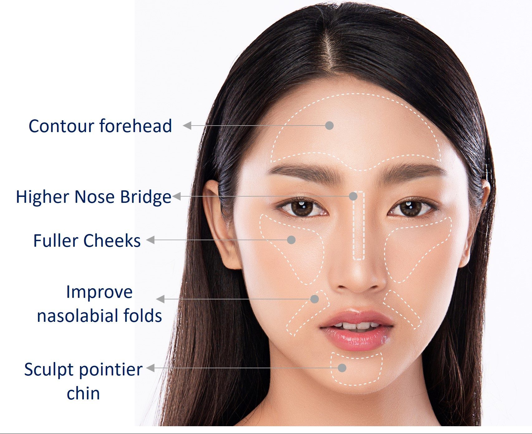 face contouring with filler