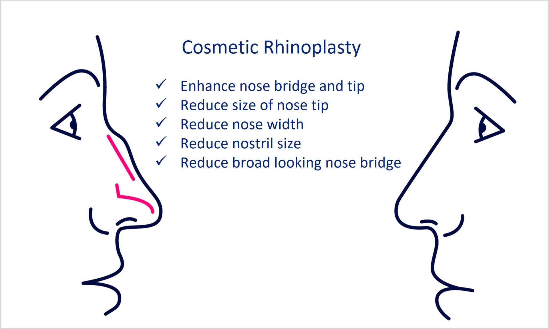 cosmetic - aesthetic rhinoplasty
