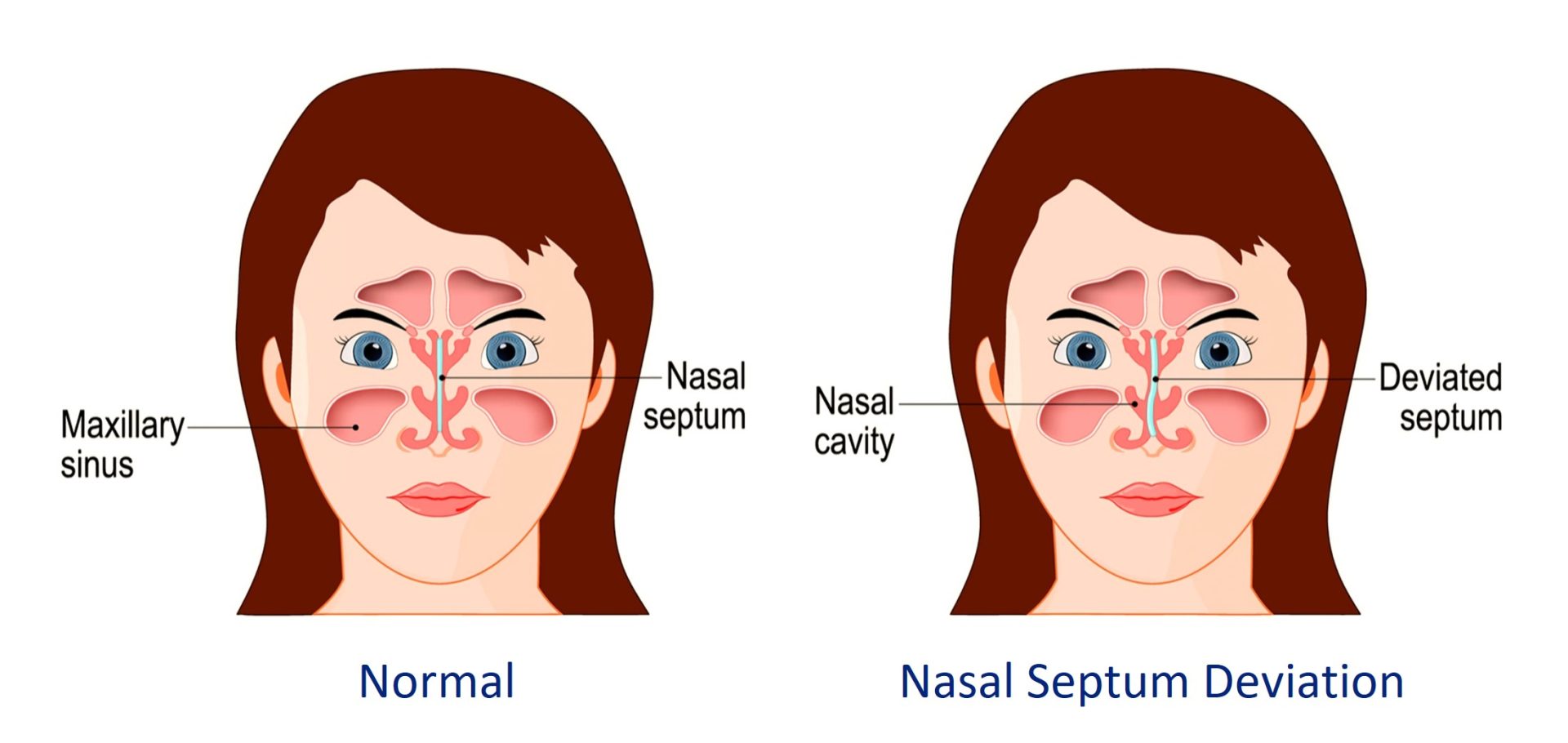 deviated nasal septum