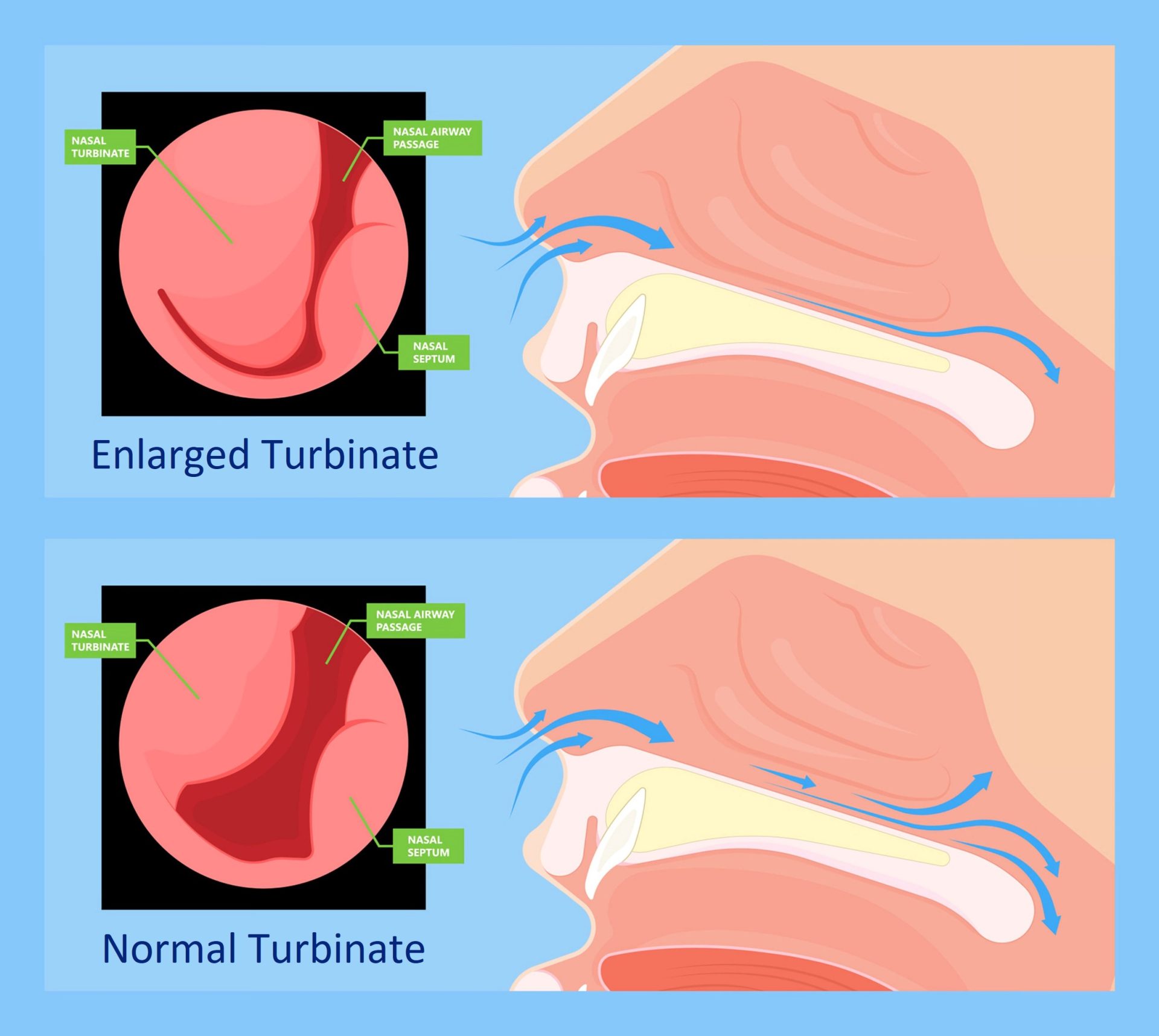 enlarged turbinated causing breathing problems