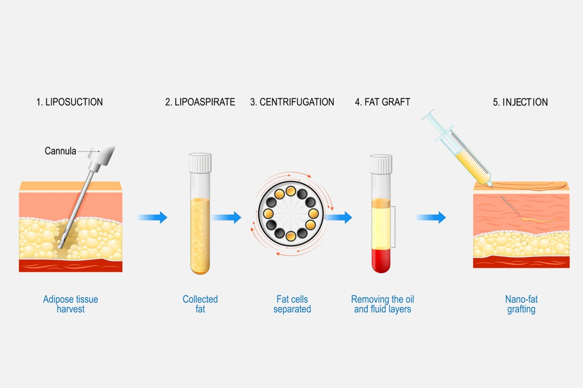 fat grafting process