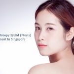 guide to droopy eyelid surgery in singapore