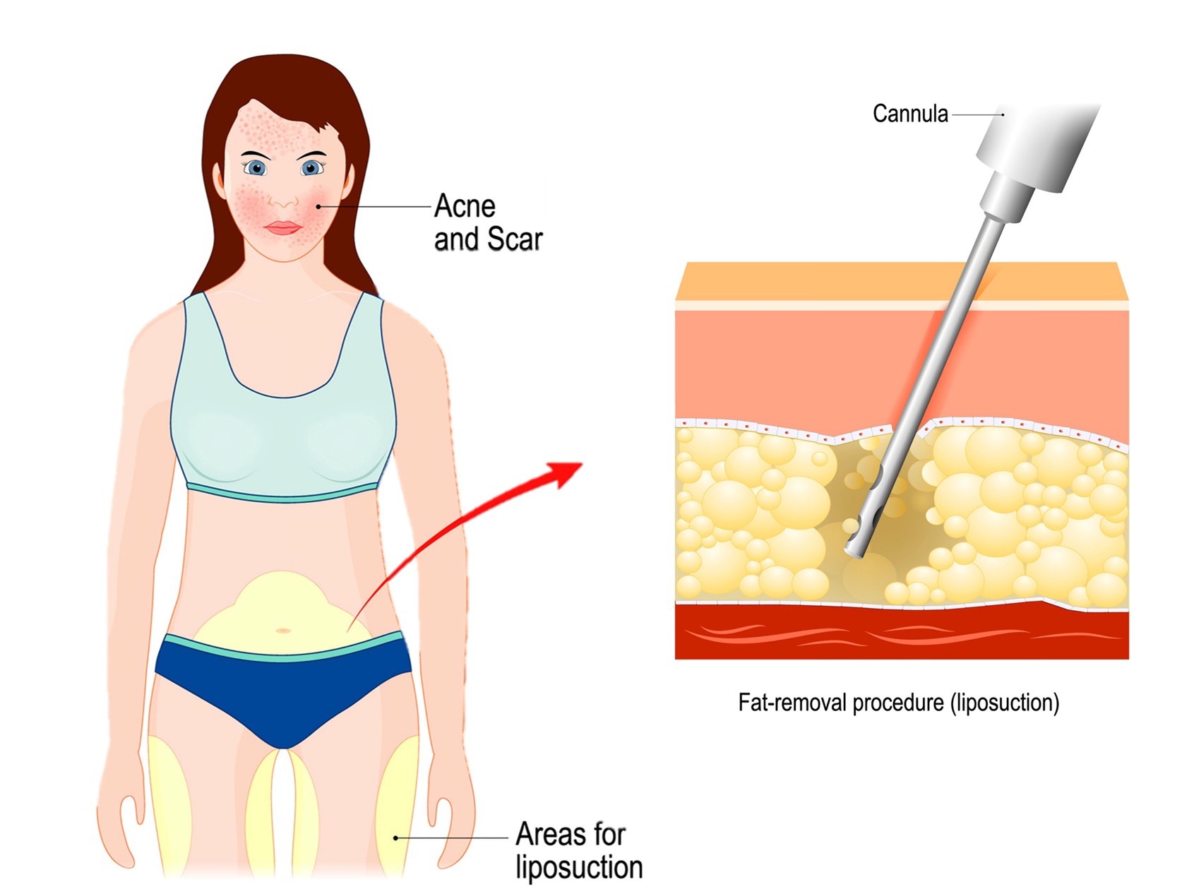 fat extraction for fat grafting