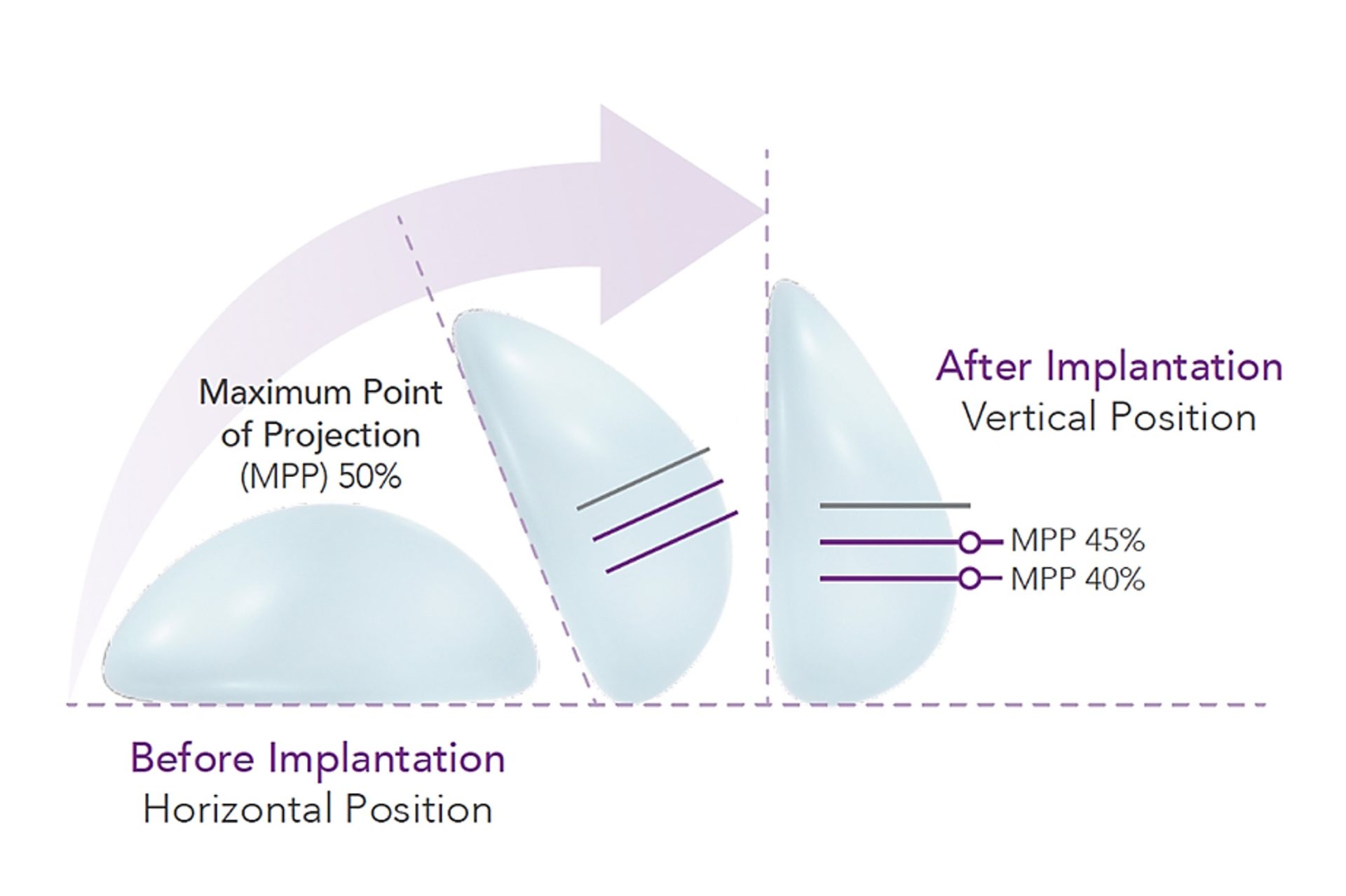 Comparison Of Breast Implants In Singapore: How It Affects Your Breast  Augmentation Results?