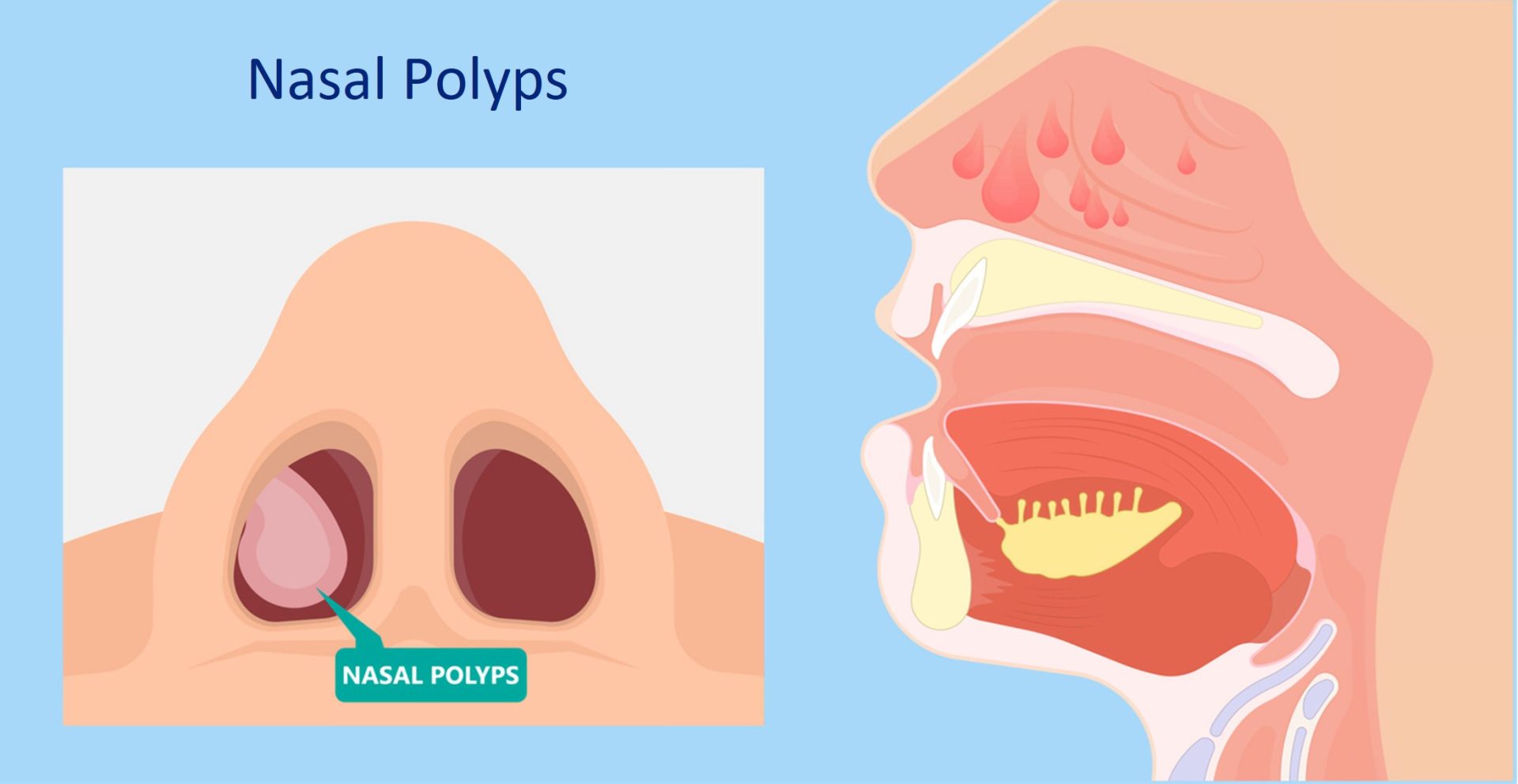 nasal polyps causing breathing problems
