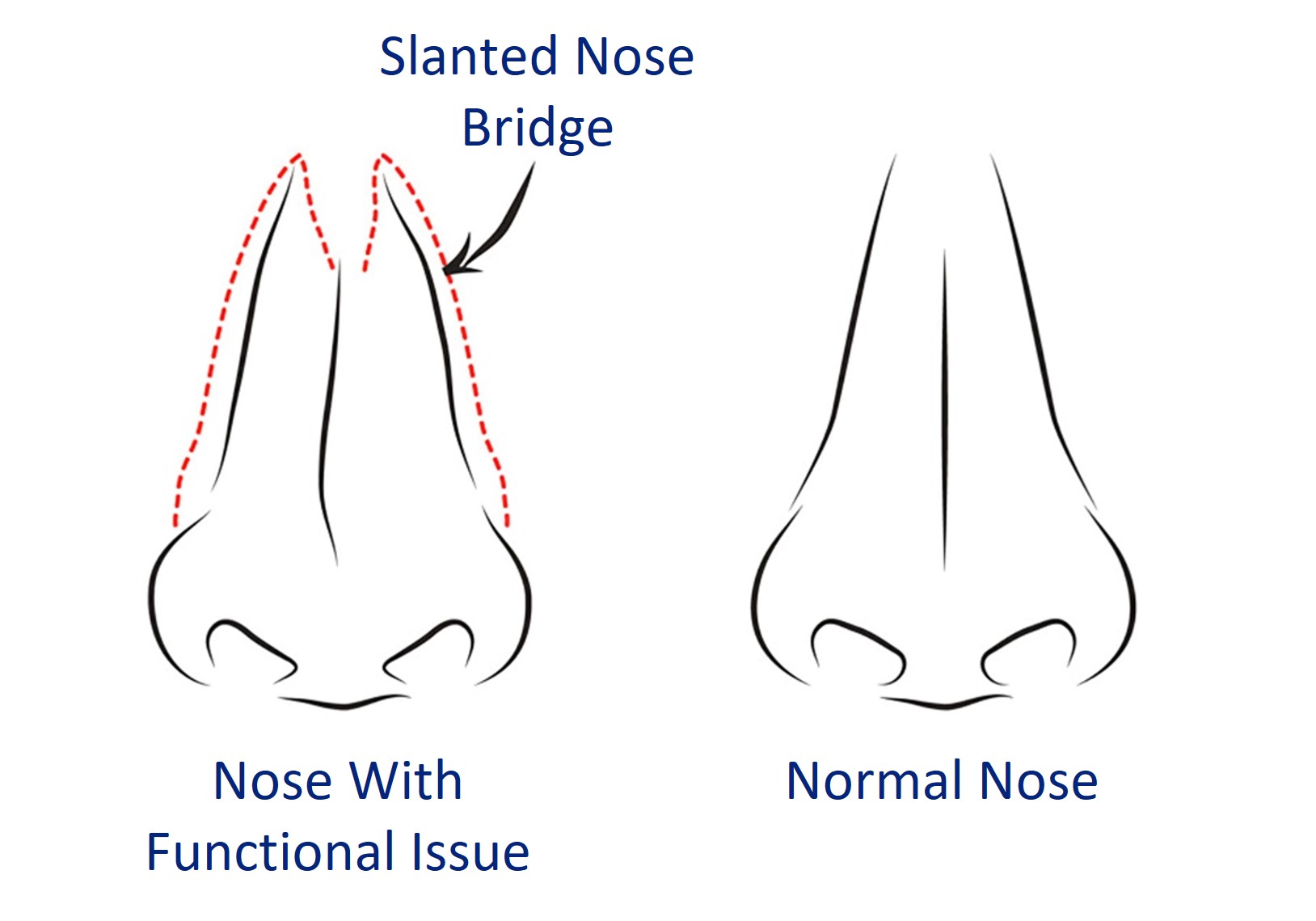 normal vs crooked nose or deviated septum