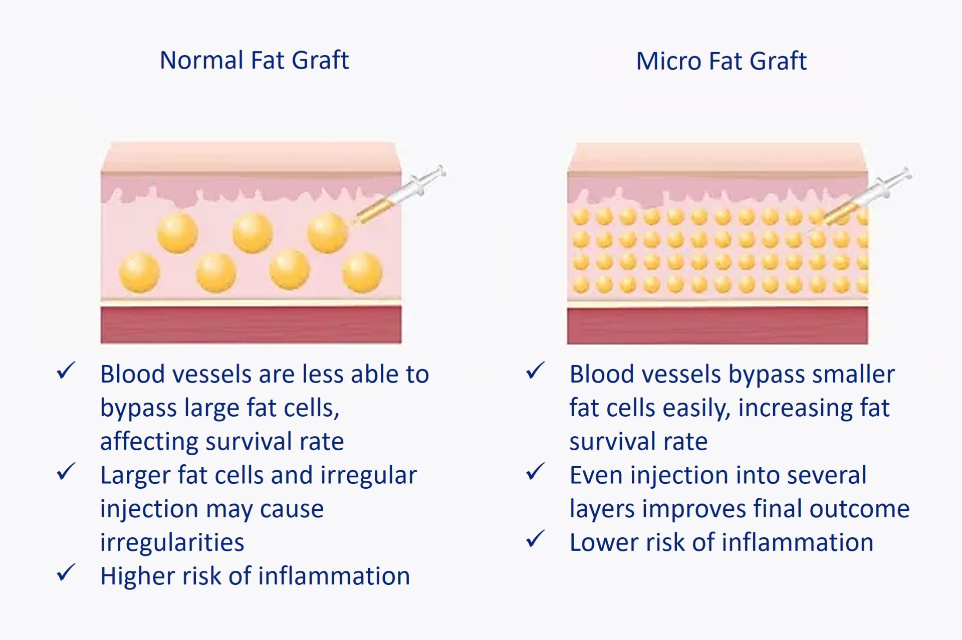 normal versus micro fat grafting
