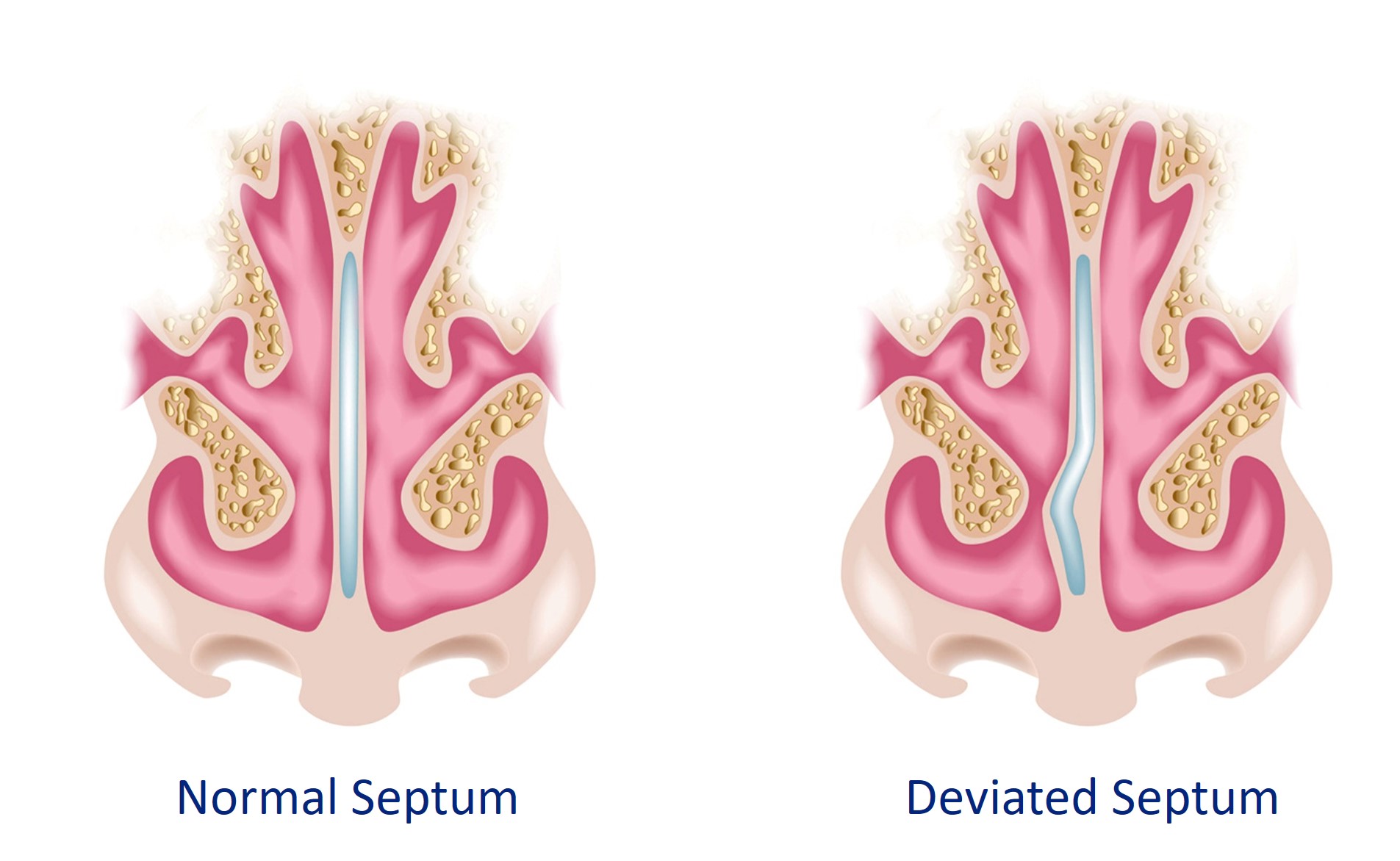 normal vs deviated septum
