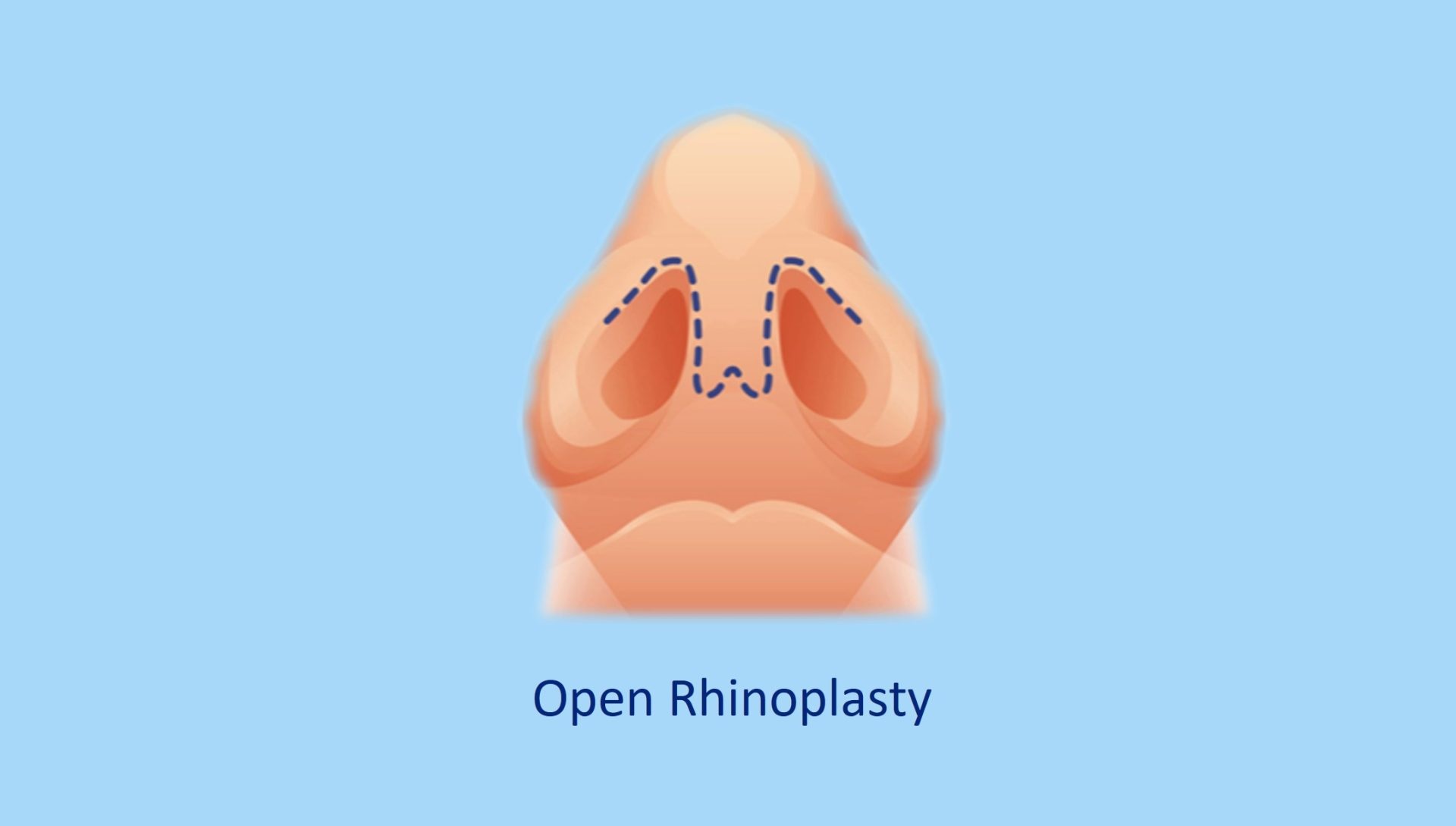 open rhinoplasty technique