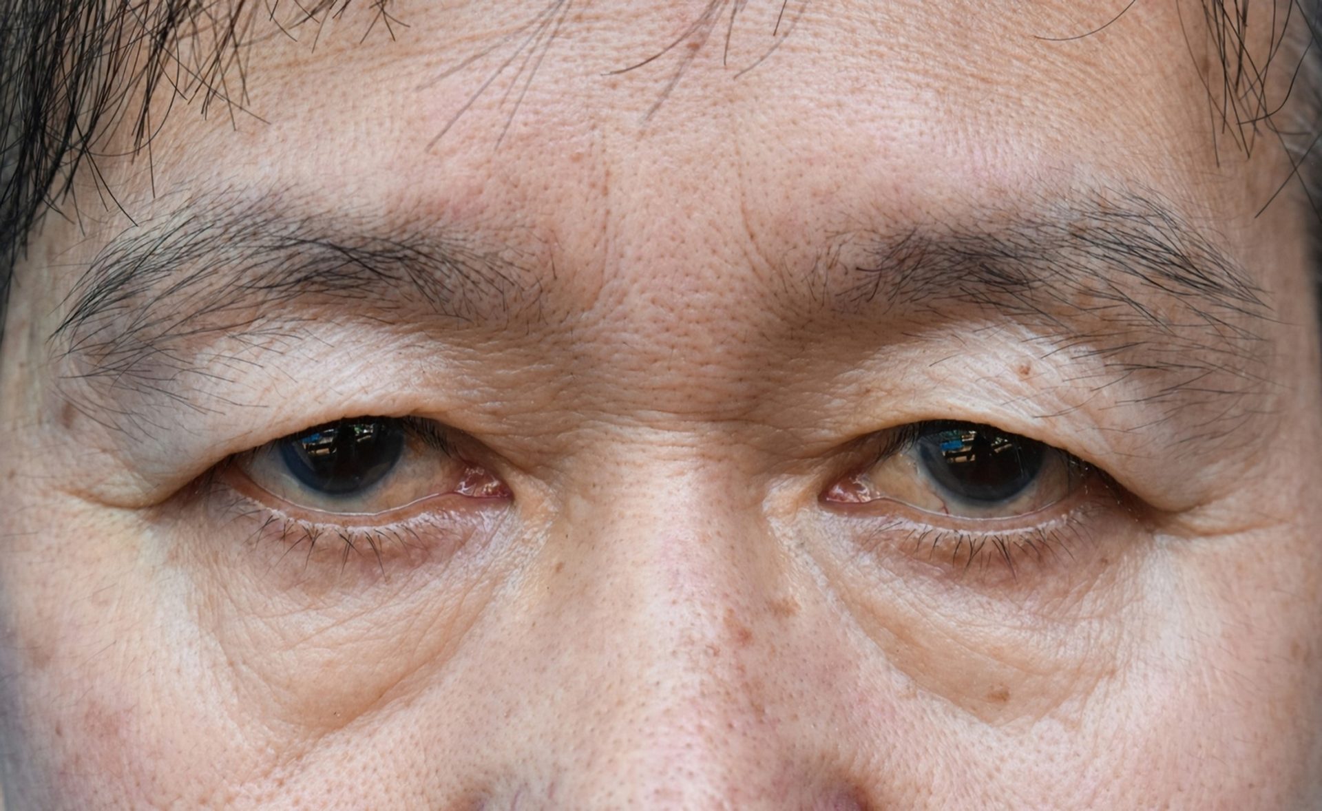 ptosis due to aging