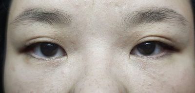 ptosis eyelid condition