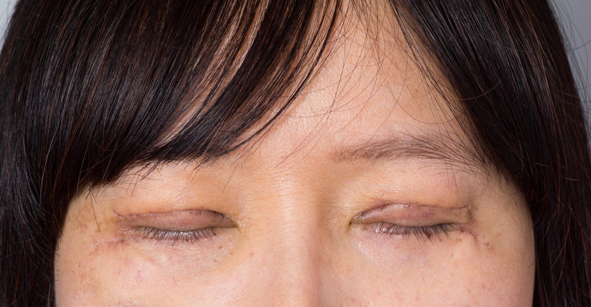 recovery after ptosis surgery