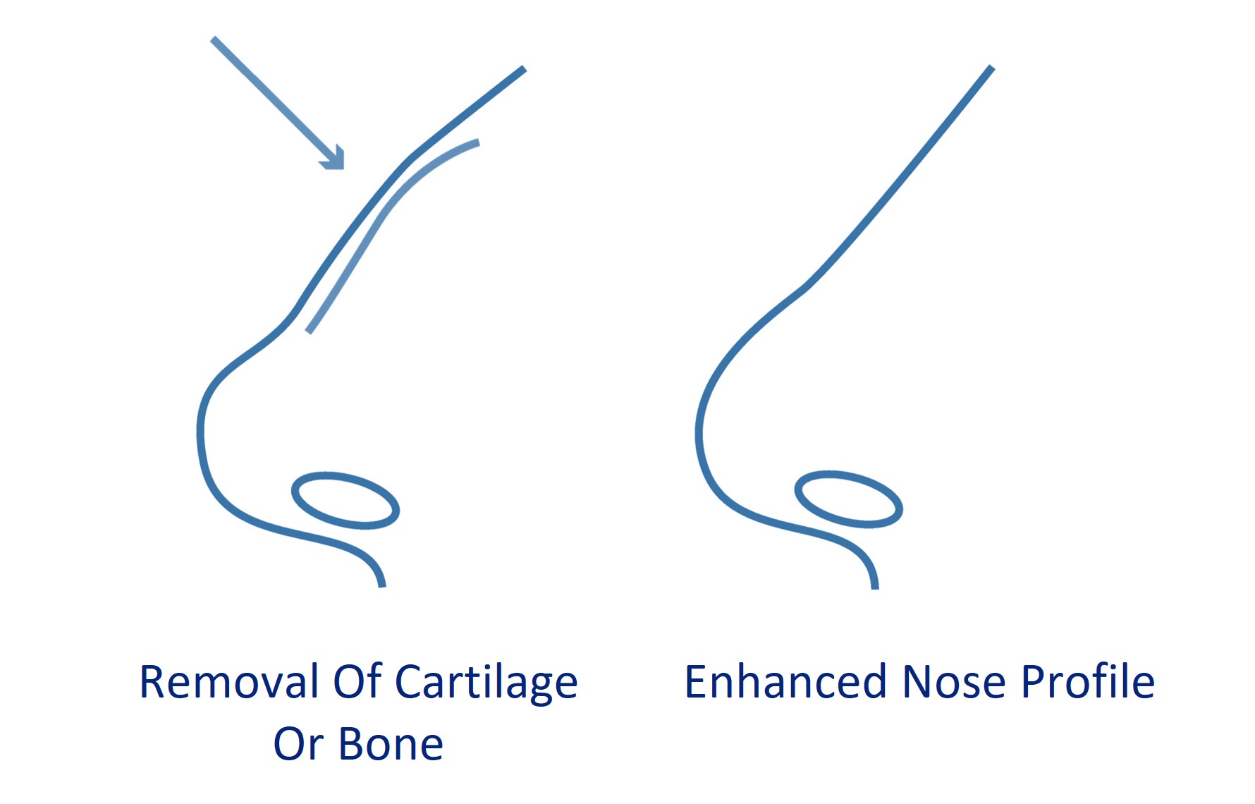 removal of hump on nose