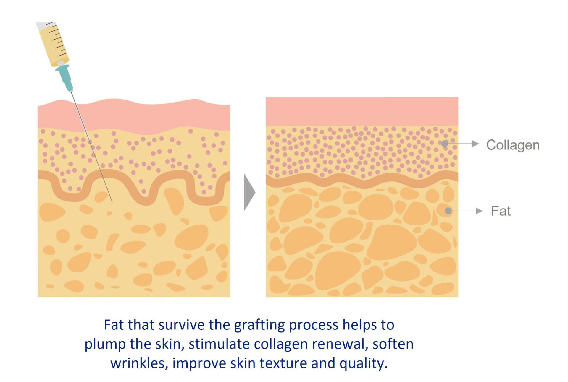 results after fat grafting