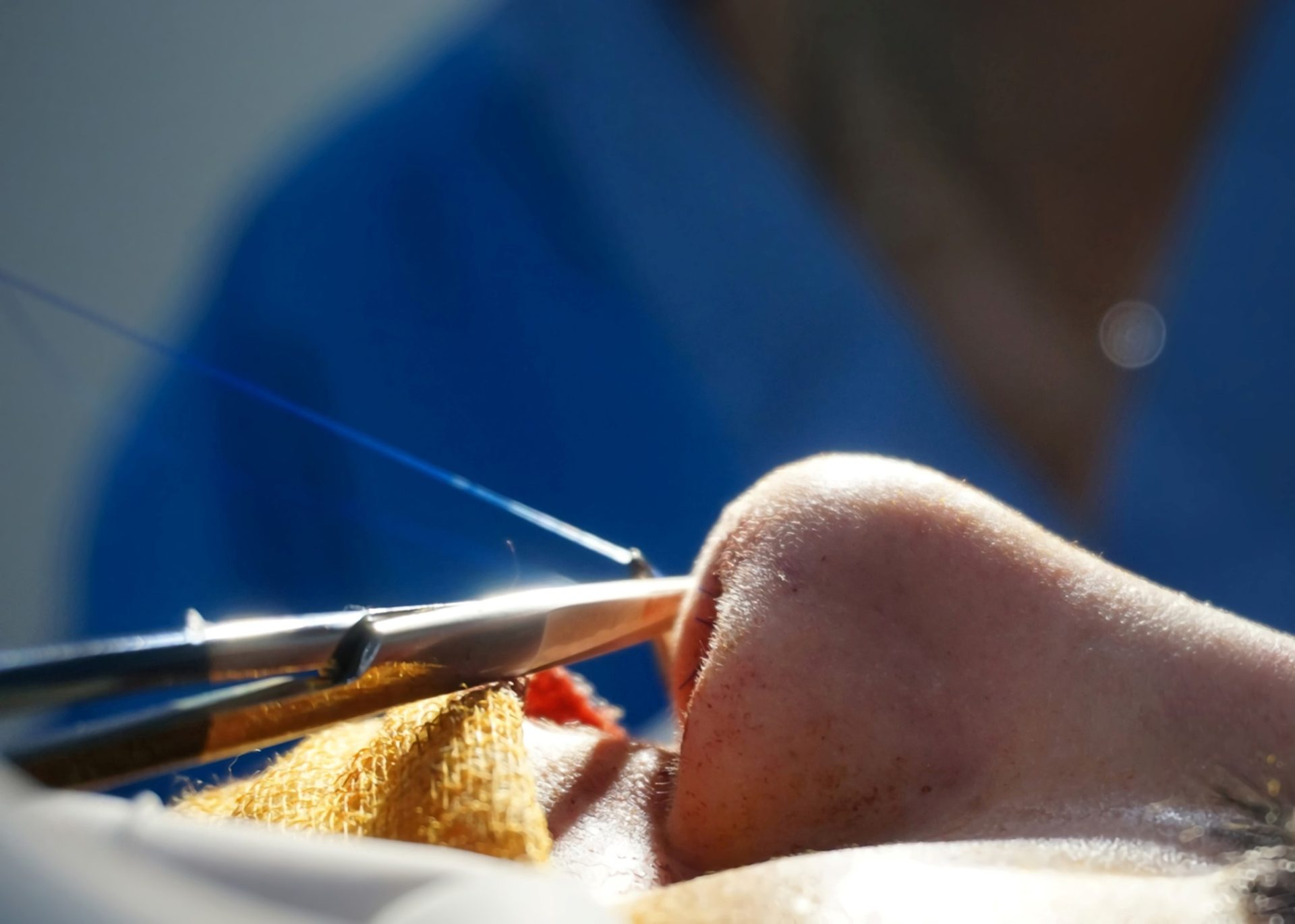 rhinoplasty surgery procedure