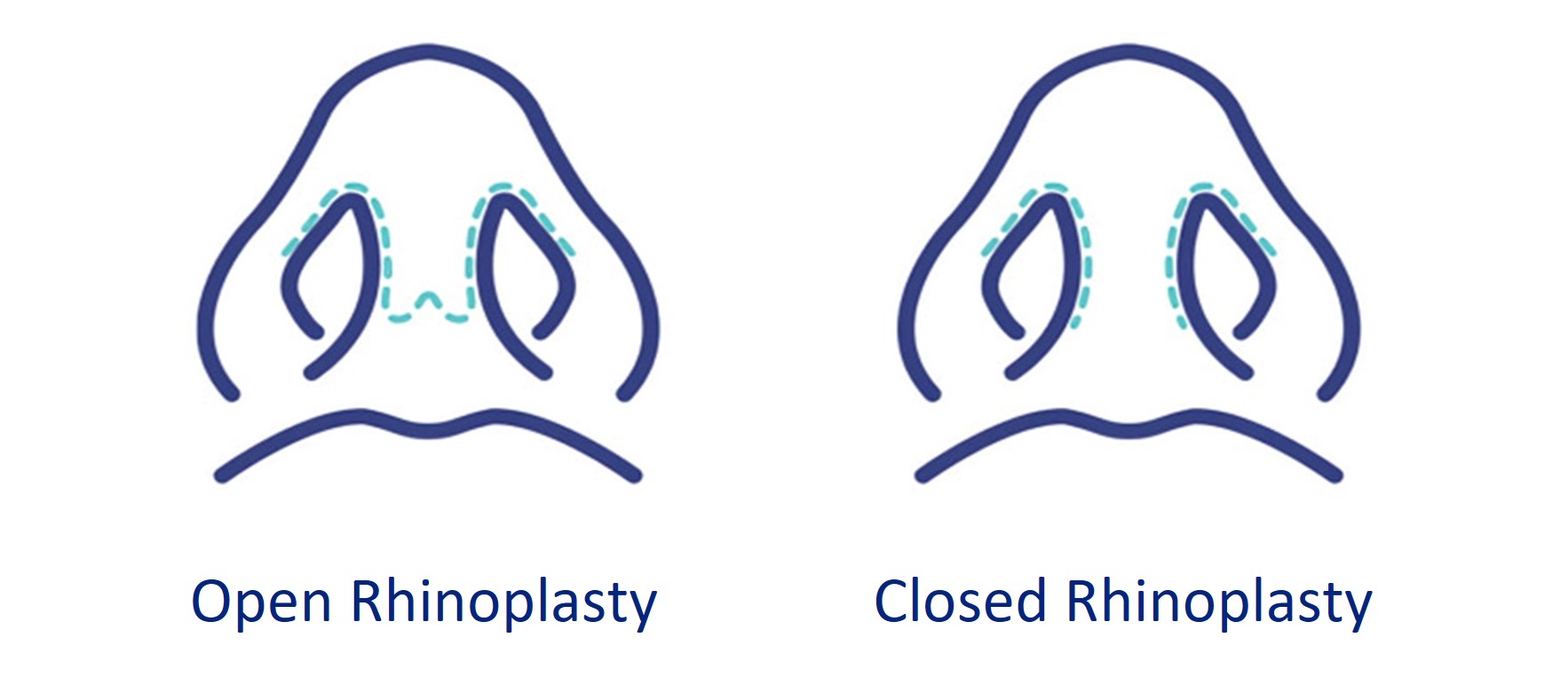 open and close nose surgery technique - rhinoplasty