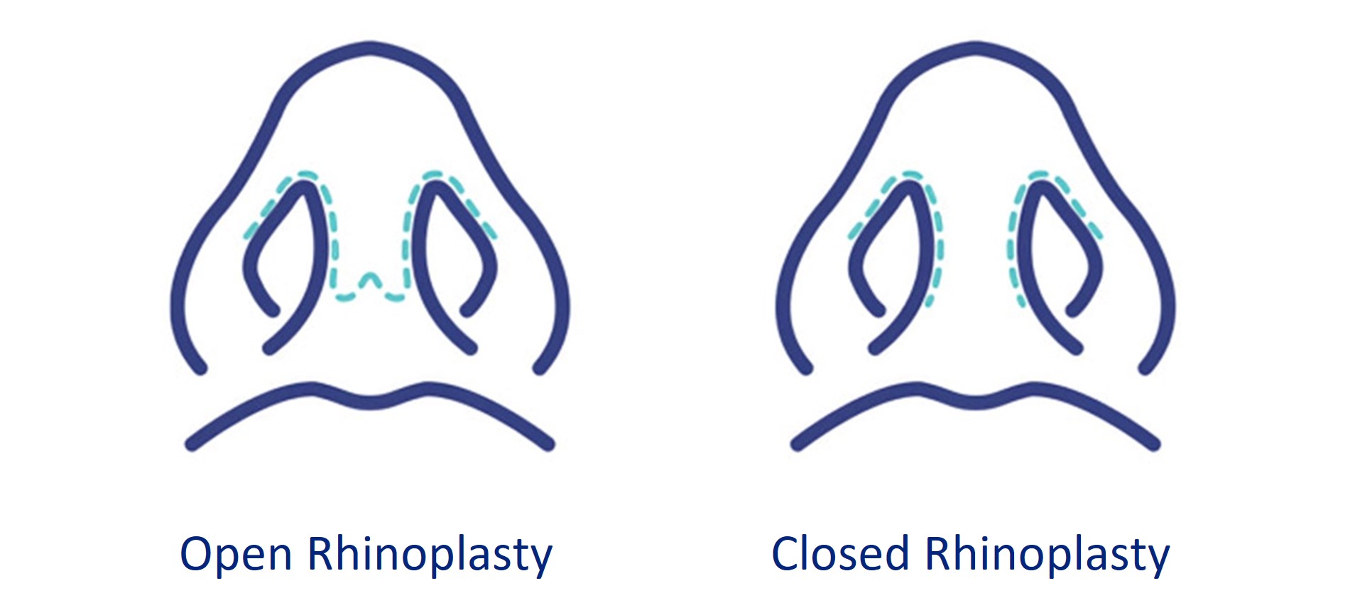 open and close rhinoplasty techniques