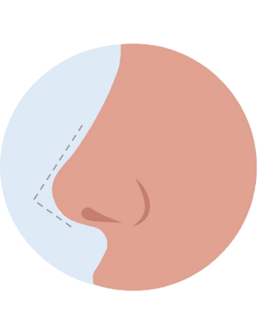 sharper nose tip - nose tip reduction