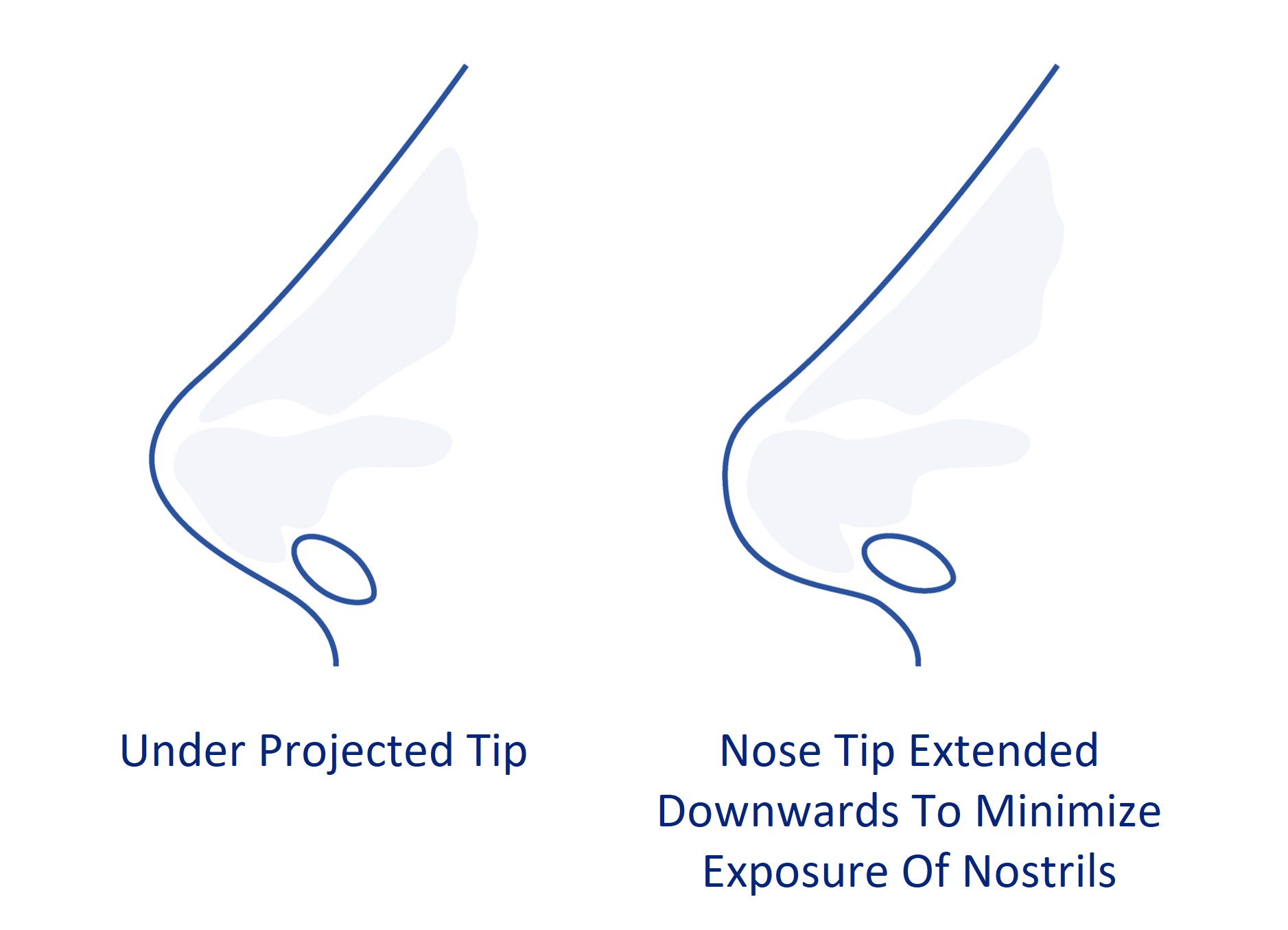 short nose extension