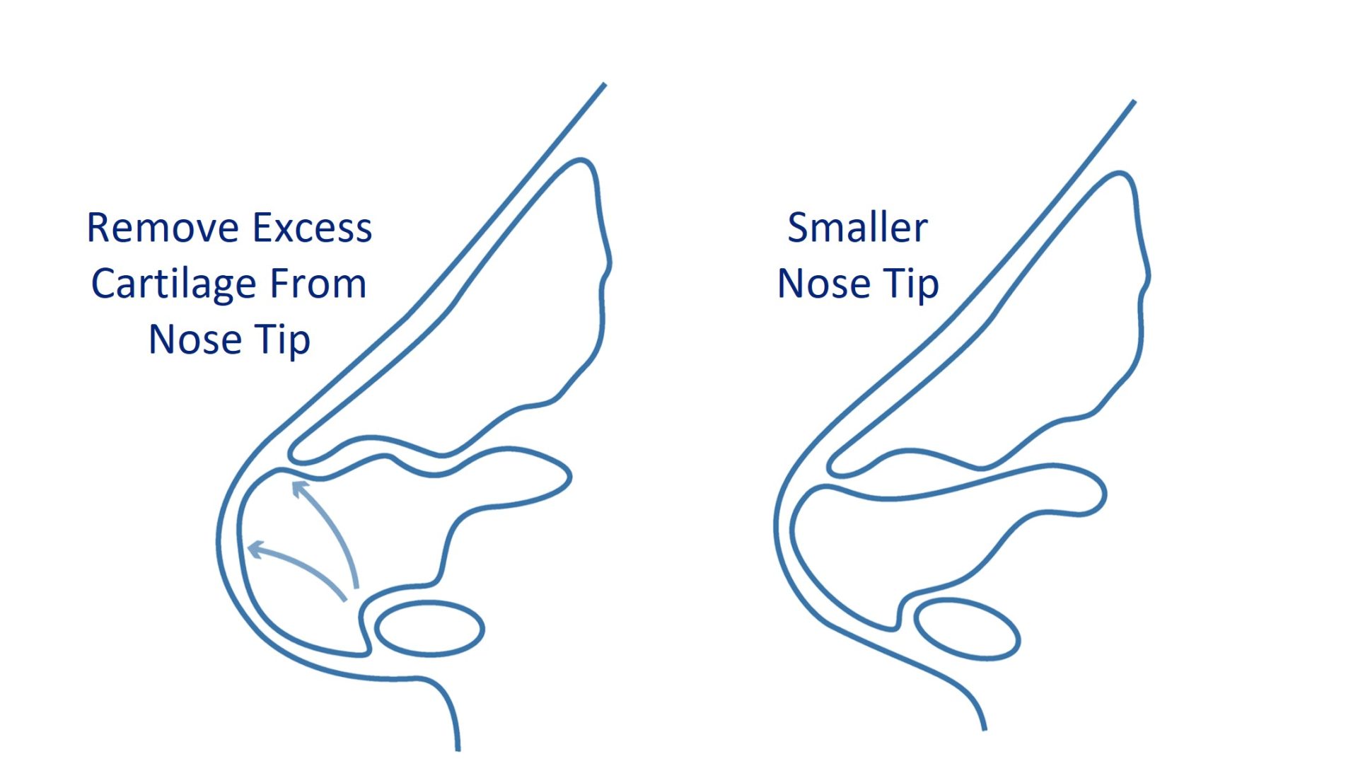nose tip reduction