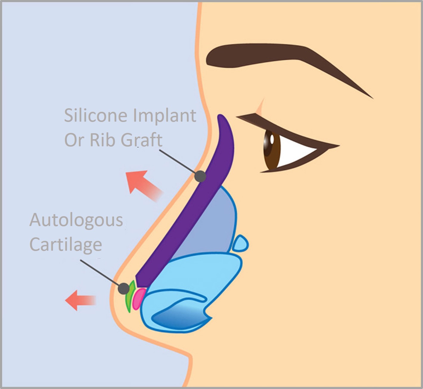 rhinoplasty using silicone implant