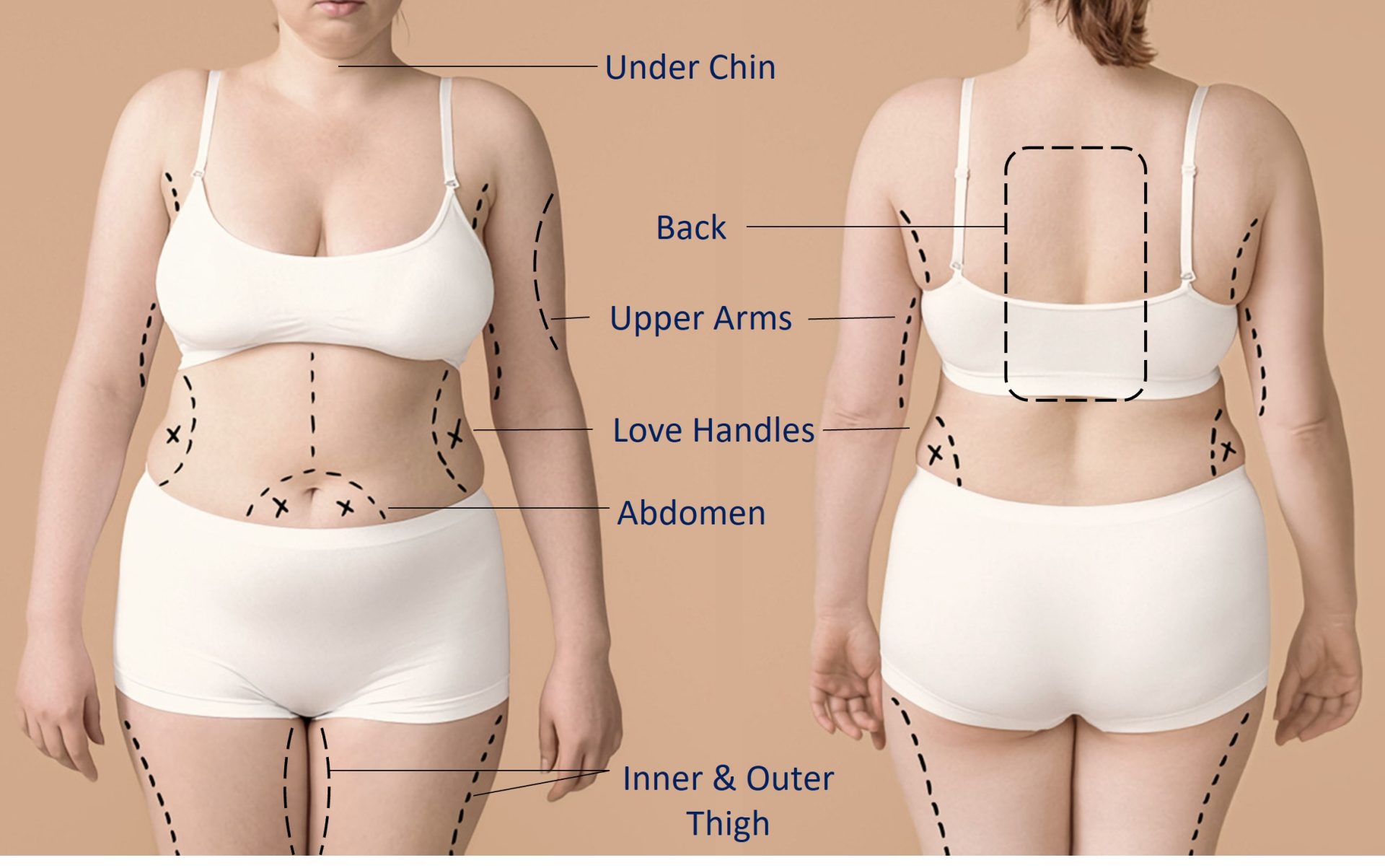 areas suitable for liposuction
