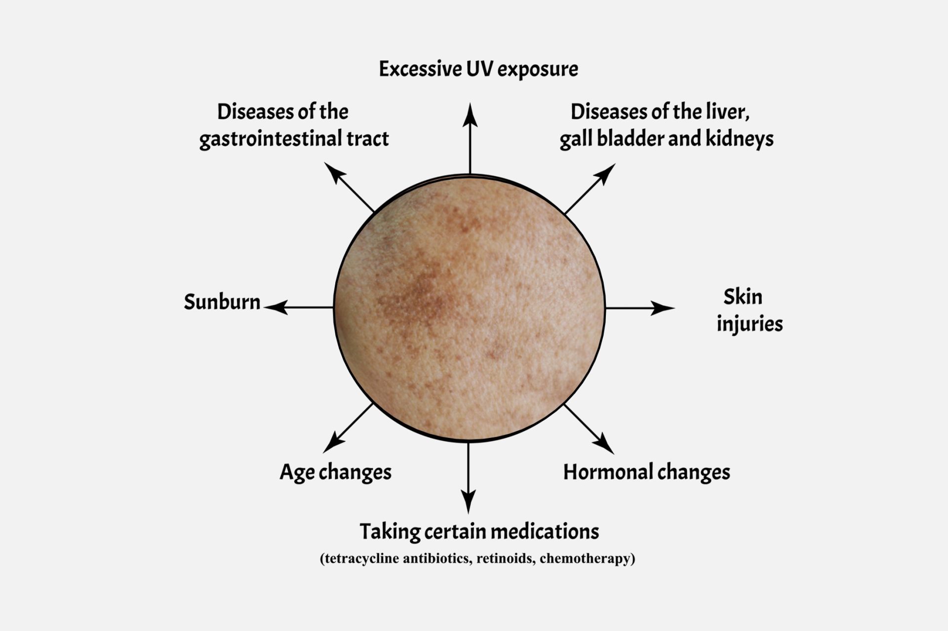 causes of pigmentation