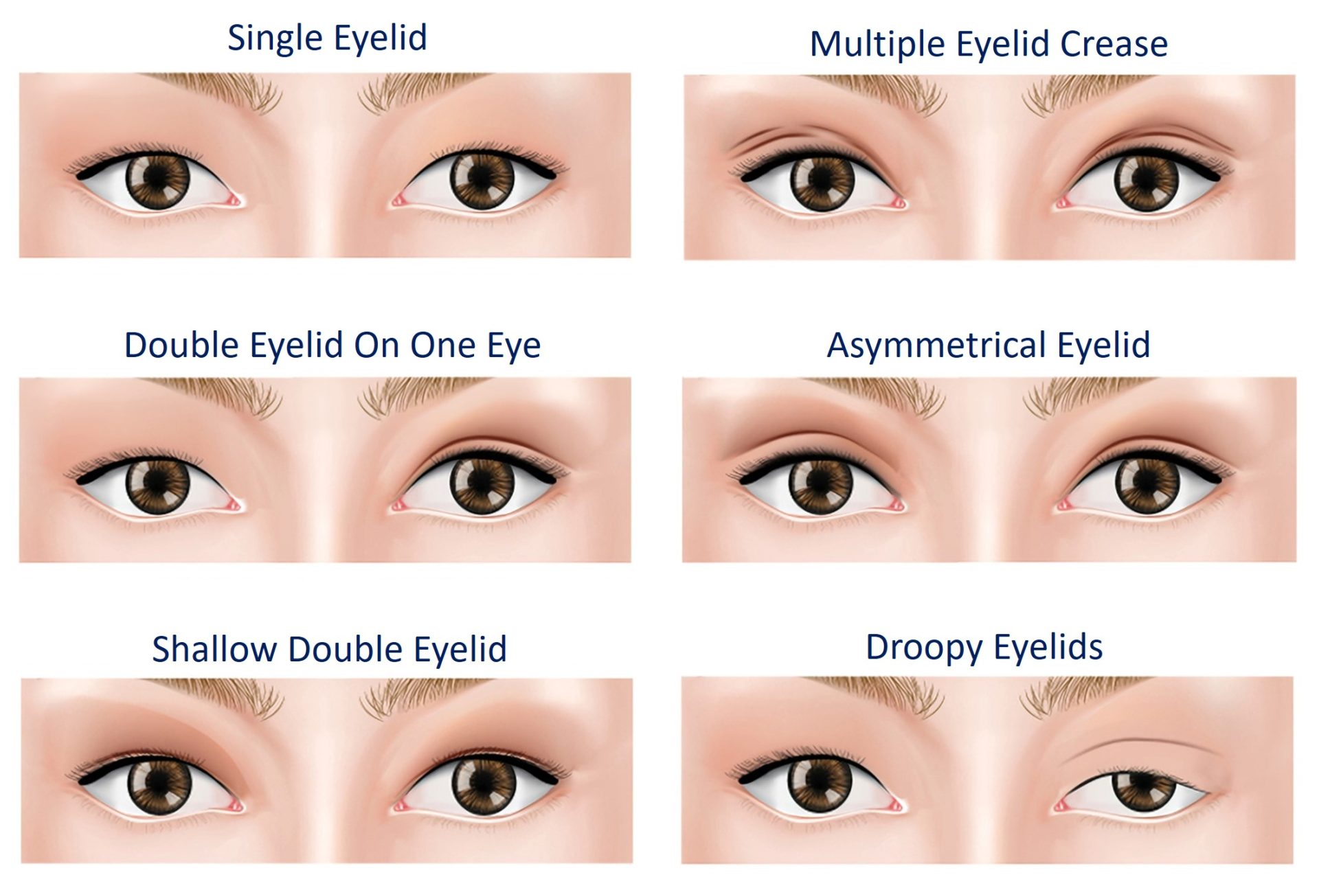 condition suitable for double eyelid surgery