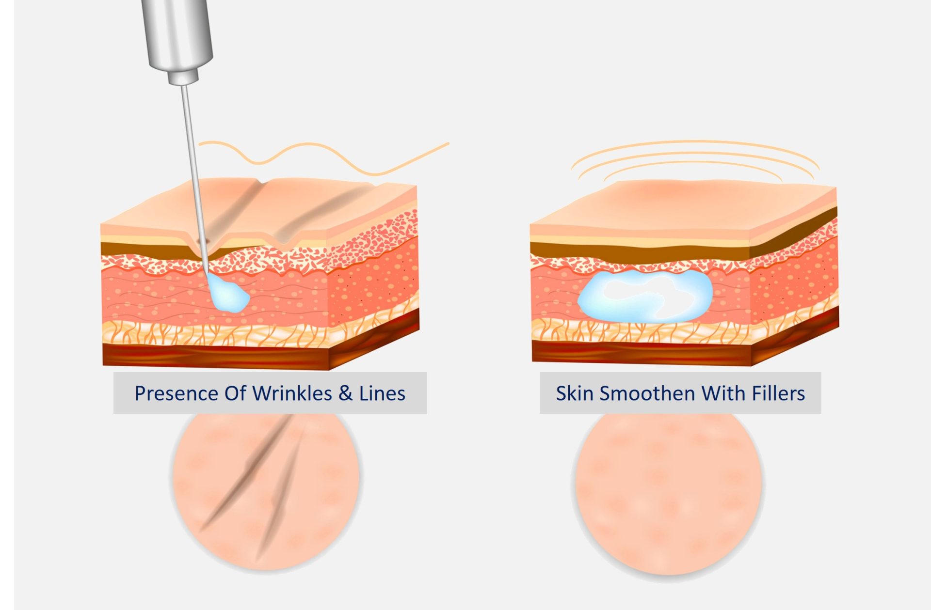 effect of filler in skin