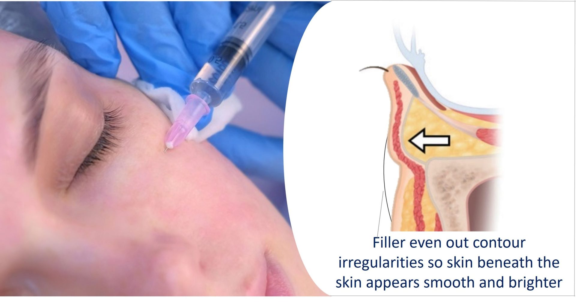 eye bag filler treatment
