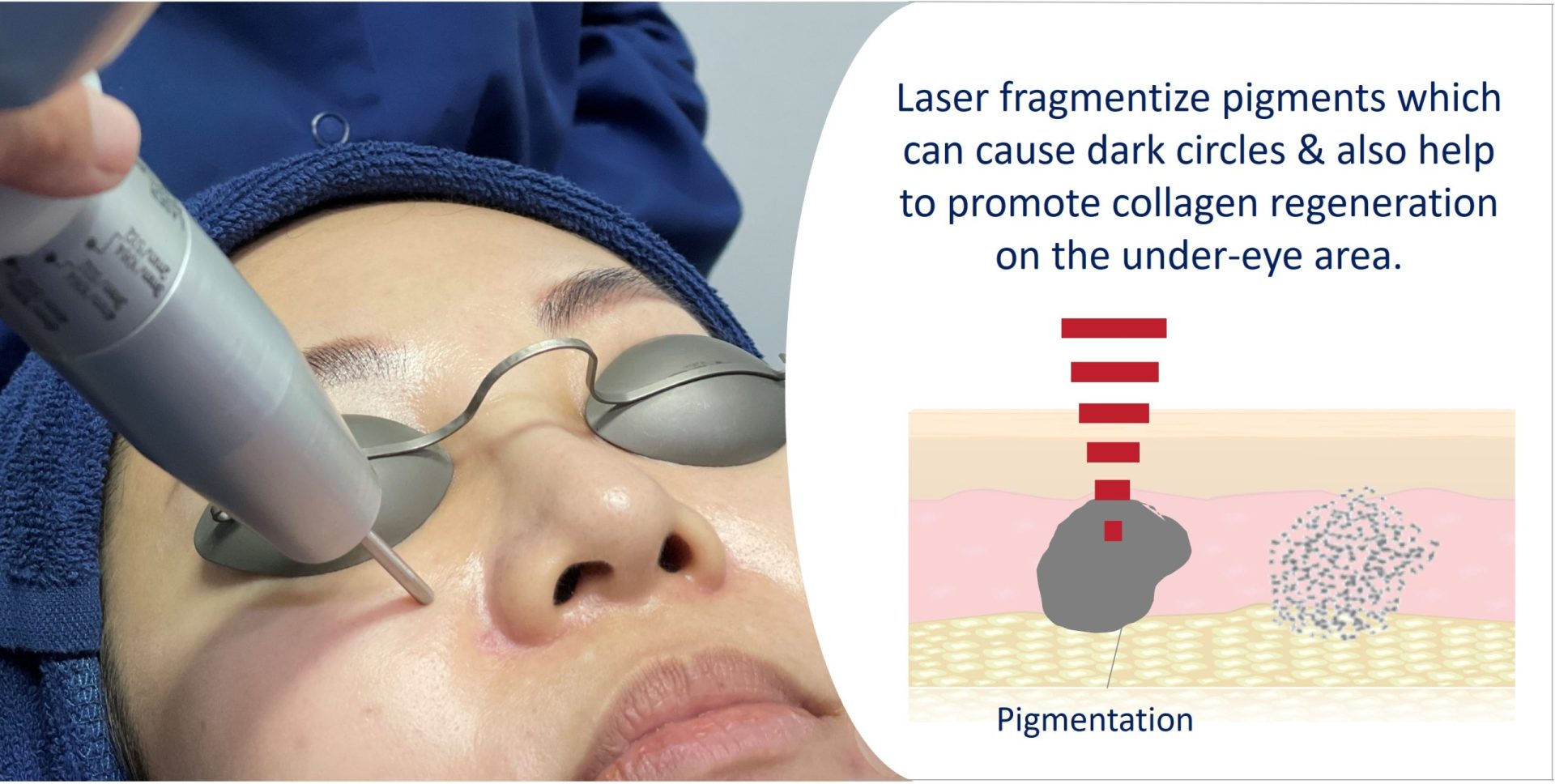 eye bag laser treatment