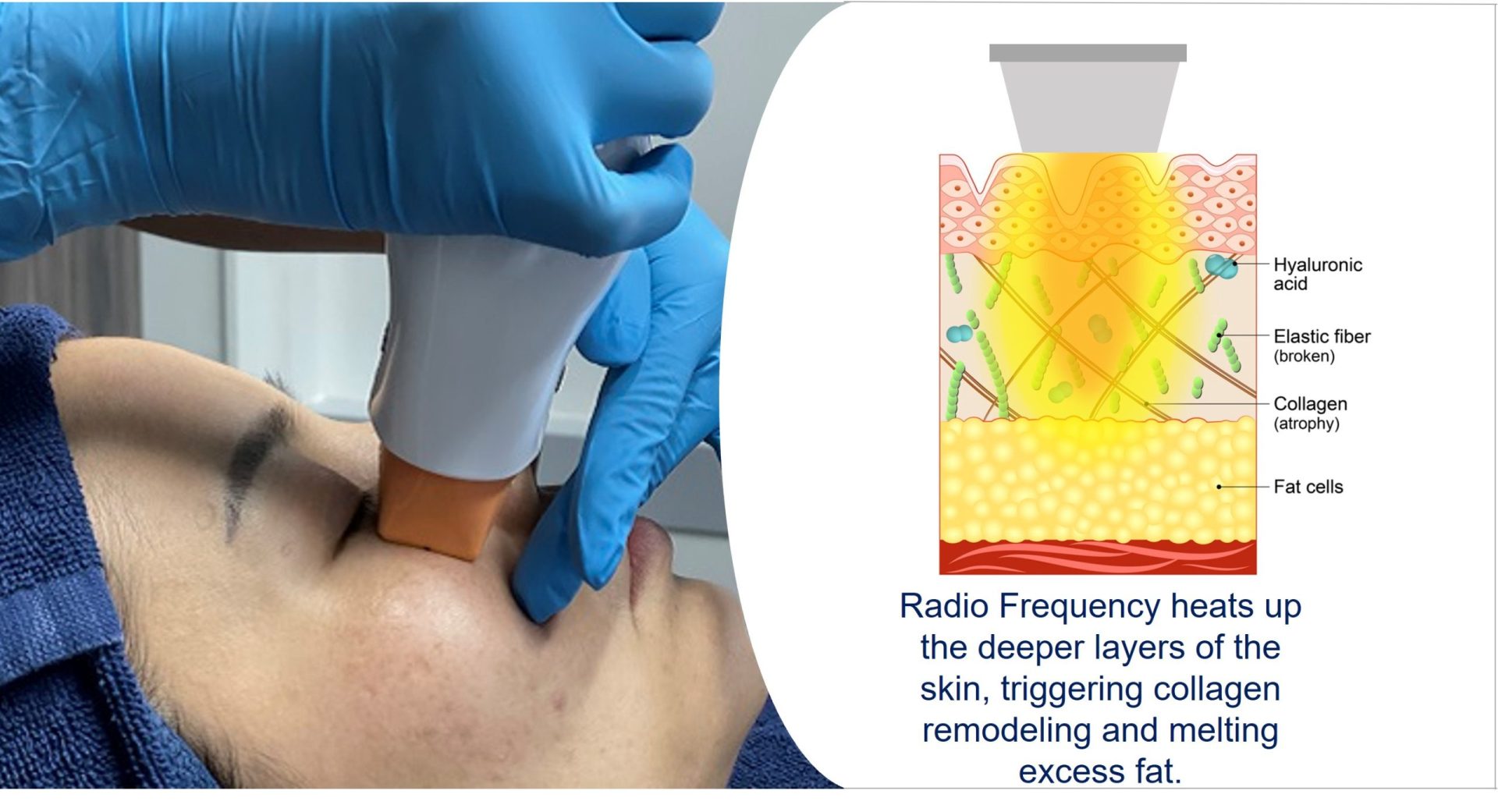 eye bag rf treatment