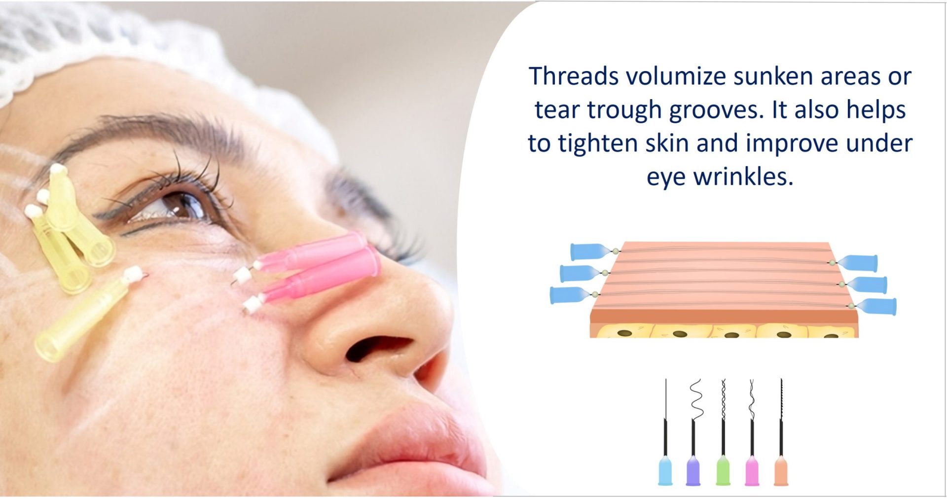 eye bag threadlift