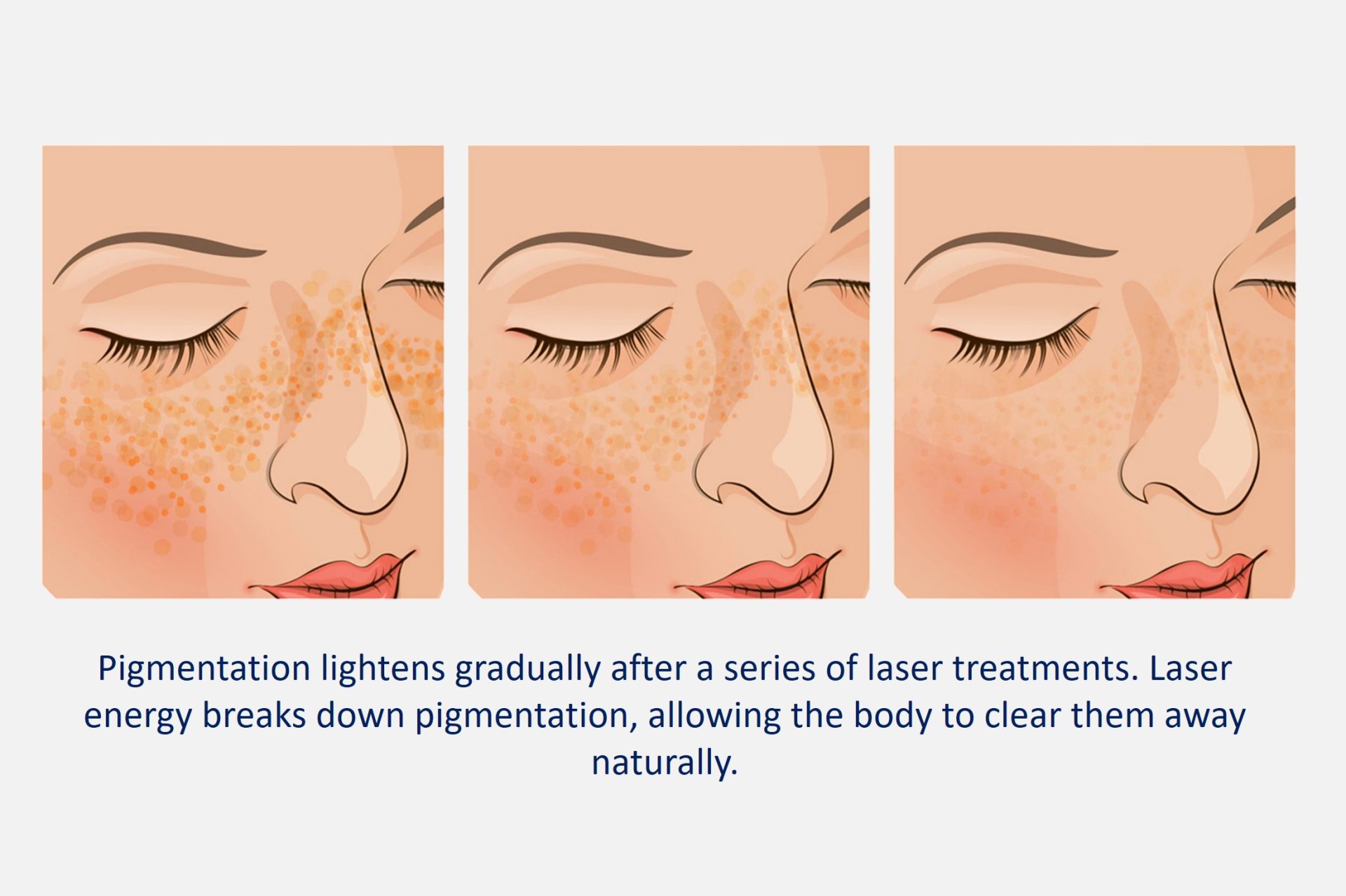 gradual improvements in pigmentation after laser treatment