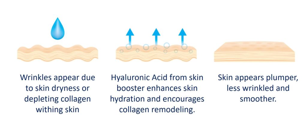 Skin Boosters: Which One To Choose & What Benefits Does Each Of Them ...