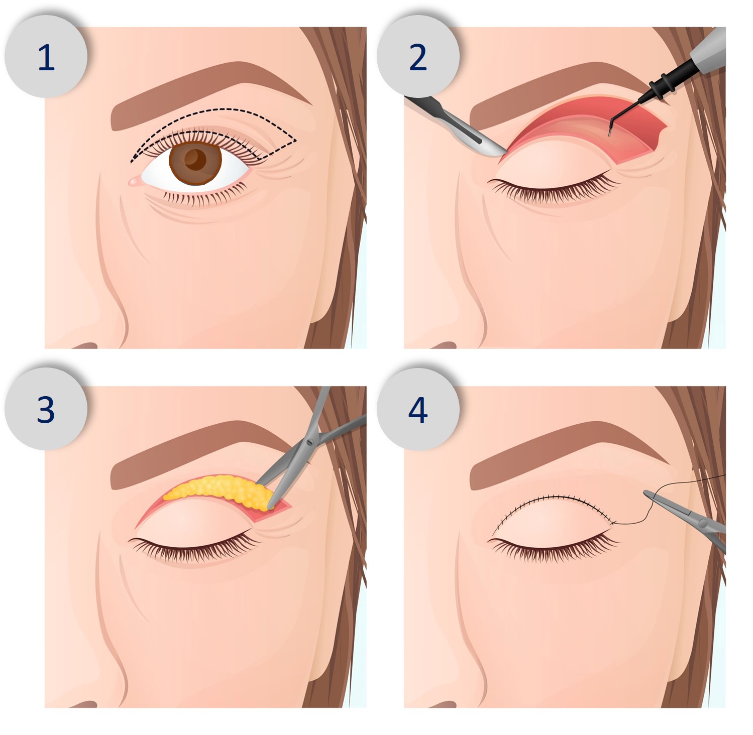 incisional double eyelid method