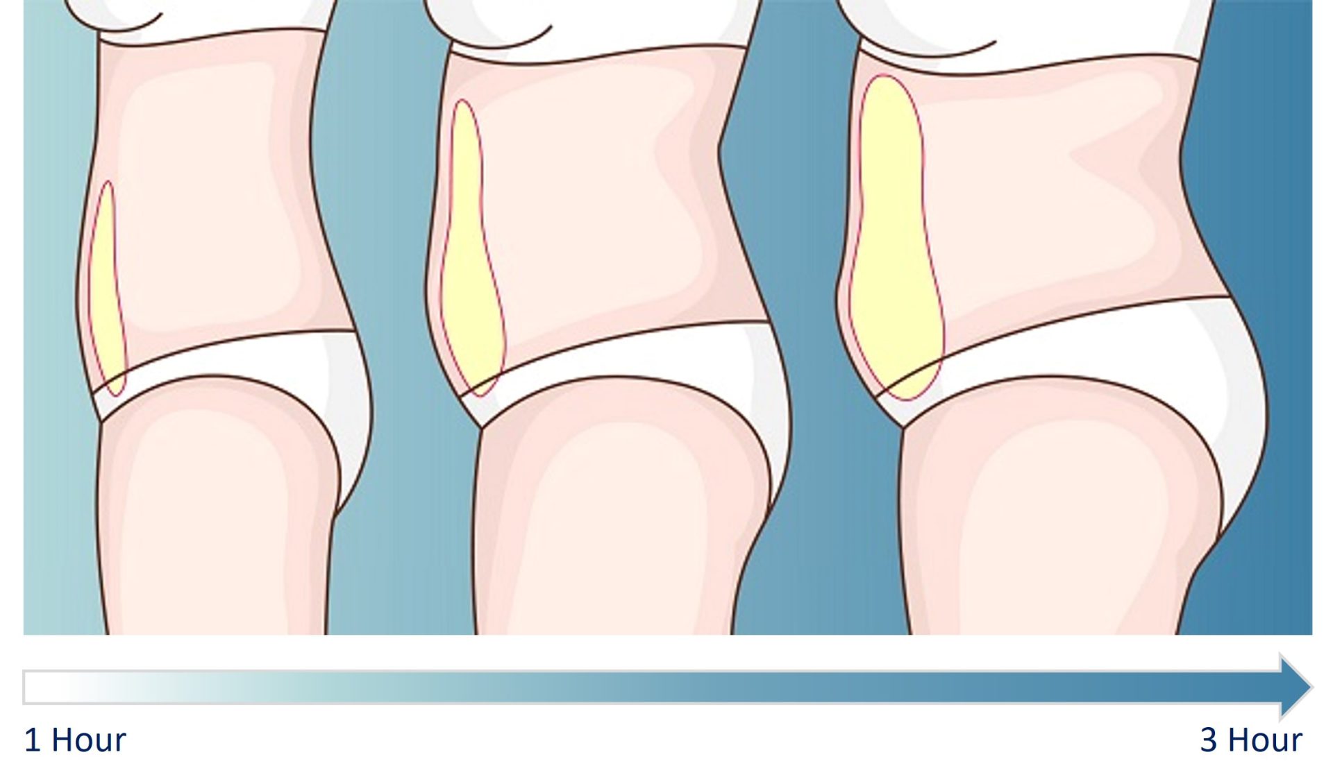 What areas of the body can be treated with liposuction