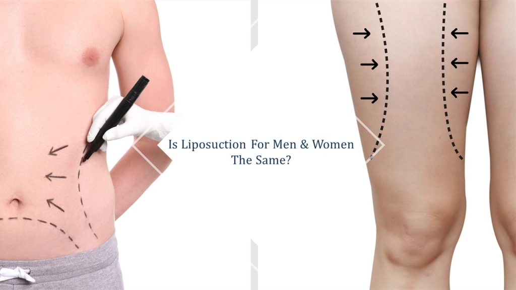 liposuction for men and women singapore