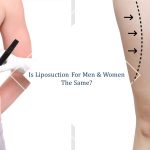 liposuction for men and women singapore