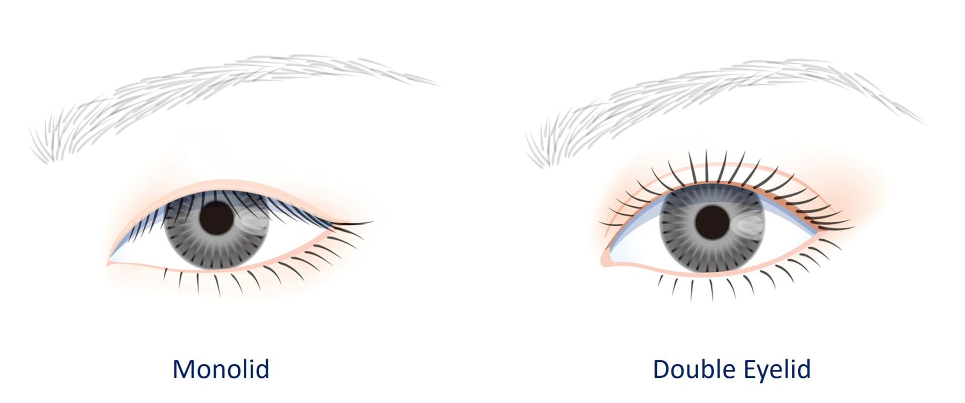 monolid vs double eyelid