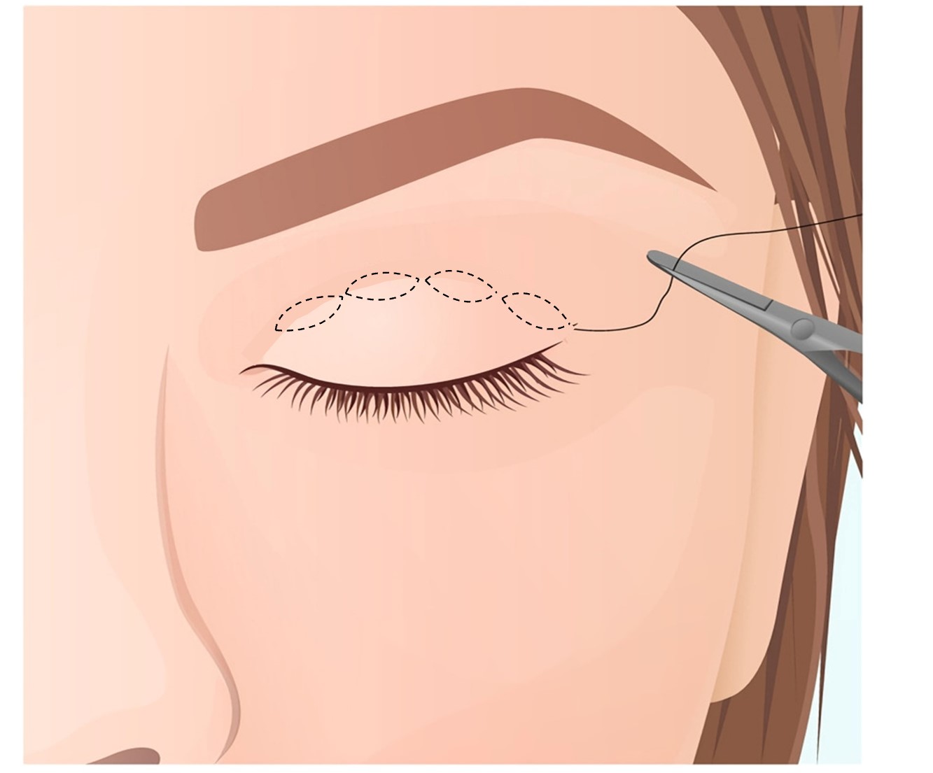 non-incisional double eyelid technique