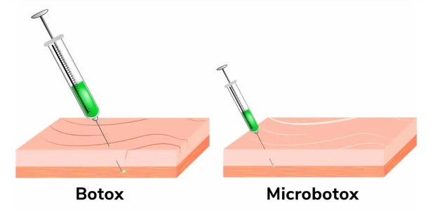 botox injection techniques