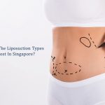 liposuction types in singapore