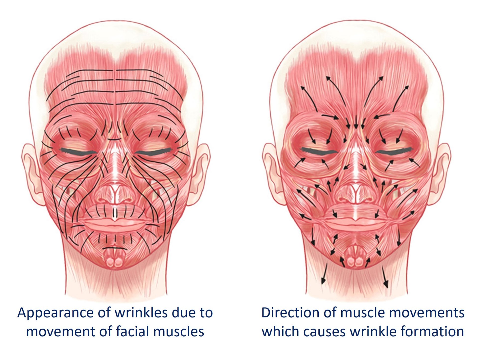 wrinkle formation from facial muscle movements