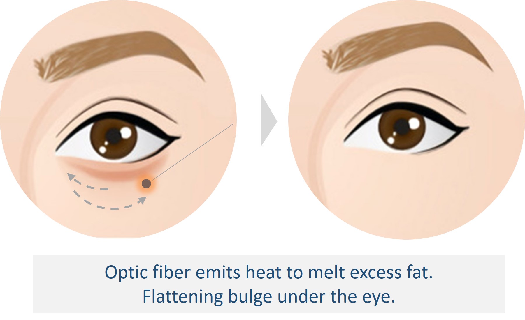 laser lipolysis eye bag removal singapore