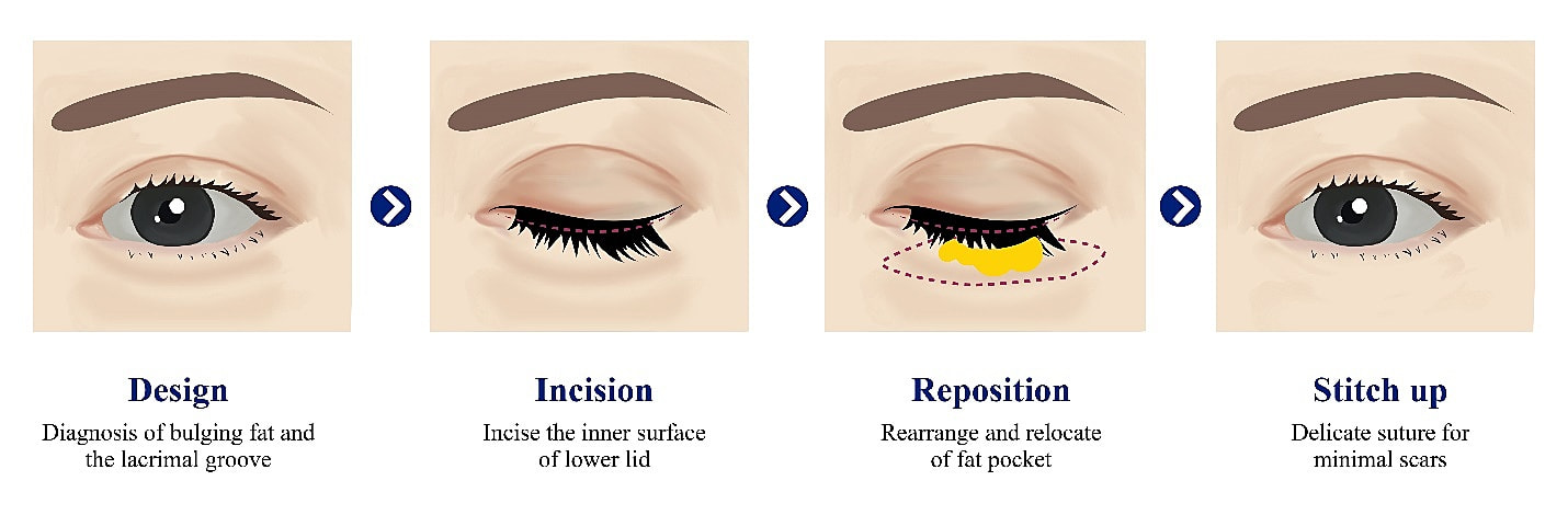 Eye Fat Repositioning Surgery